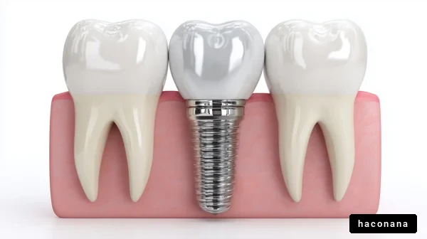 歯科インプラントの模型