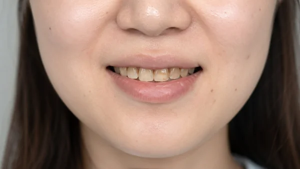 歯の黄ばみ・着色が気になる女性