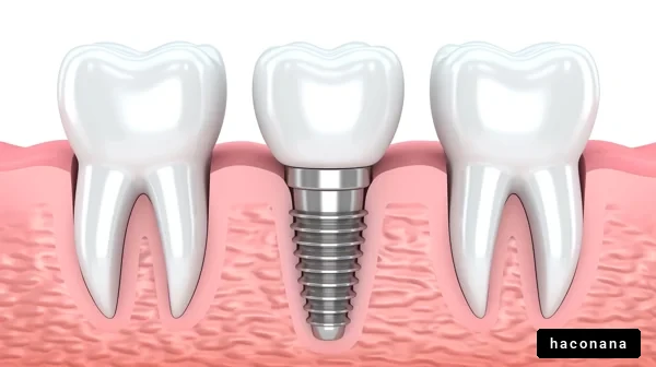 歯科インプラントのイラスト